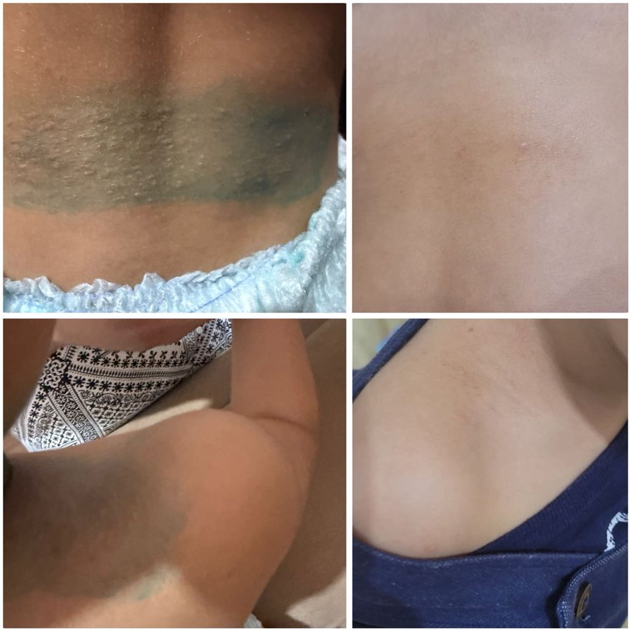 Dermatite de contato em criança de 3 anos, antes e depois do uso de FlamiActiv®, mostrando redução da irritação em 1 dia