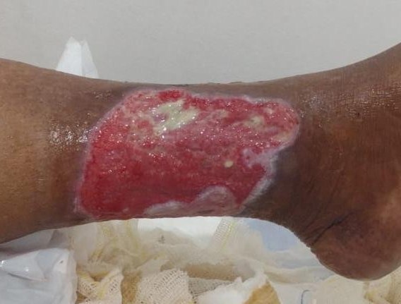 Mesma lesão vascular após 28 dias de tratamento com Flaminal® Hydro, com tecido de granulação saudável
